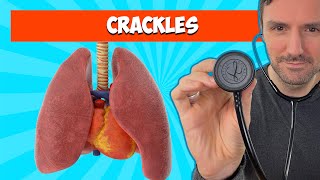 Fine and Coarse Crackles Lung Sounds For Beginners 🔥🔥🔥 [upl. by Elinad651]