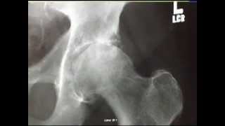 Diagnosing an Arthritic Hip Joint [upl. by Jabin979]