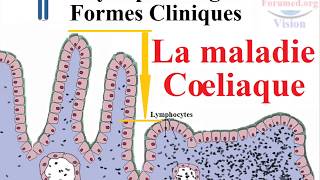 Maladie coeliaque physiopathologie et les Causes des Symptomes [upl. by Oine]