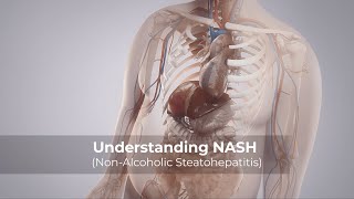 Understanding NASH NonAlcoholic Steatohepatitis [upl. by Tsyhtema]