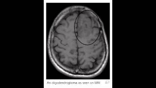 Oligodendroglioma [upl. by Christoffer]