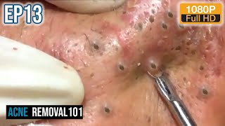 Cystic Acne Extraction 32mn  Blackheads Removal by ACNEREMOVAL101 [upl. by Fulbright]