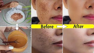 In 3 UsesRemove Pigmentation Dark Spots Acne Marks Melasmaजड़ से ख़त्म Get Bright Spotless Skin [upl. by Delamare]