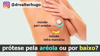 CICATRIZ Protese de Silicone pela Aréola ou por Baixo Dr Valter Hugo [upl. by Airtened]