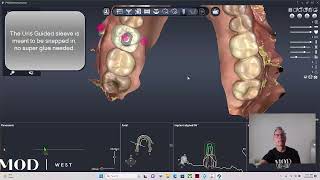 Pylon Free 3D Printed Surgical Guide Walkthrough [upl. by Kapoor]