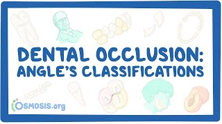 Dental occlusion  Angle’s classifications [upl. by Ramak388]