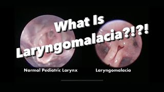 Laryngomalacia  What is it what are the symptoms how is it managed [upl. by Marvin]