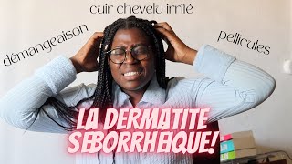 Démangeaison pellicules cuir chevelu irrité  Je souffre de dermatite séborrhéique [upl. by Amahcen]