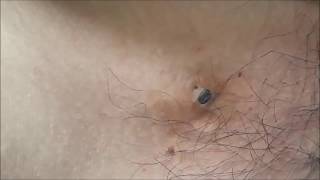 LATEST Blackheads Comedones  EXTRACTION 25 DECEMBER 2017 [upl. by Naehgem]