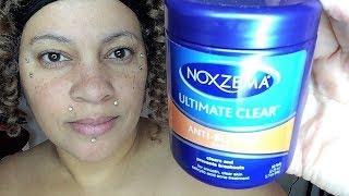 HOW I GOT RID OF ACNE WITH NOXZEMA PADS [upl. by Gaves]