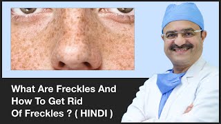 What Are Freckles And How To Get Rid Of Freckles  ClearSkin Pune  In HINDI [upl. by Gerdi408]