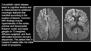 Creutzfeldtâ€“Jakob Erkrankung [upl. by Eddina]