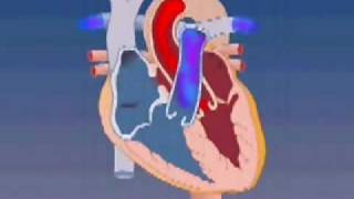 Atrial Septal Defect [upl. by Immanuel]