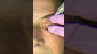 Xanthelasma removal [upl. by Dionisio]