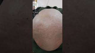 D Lapp is the South Indias first and only clinic to treat baldness without transplantation dlapp [upl. by Arsuy]