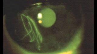 corneal abrasions [upl. by Asnerek]