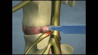 Lumbar Disc Herniations [upl. by Sisak]