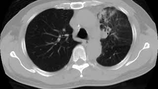 Lymphangitis carcinomatosis Ahuja AT et al 2017 Book Essential Radiology [upl. by Norabal]