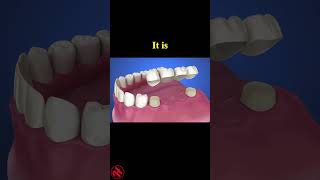 Tooth supported fixed bridge instalation process health wellness shorts [upl. by Maribeth648]