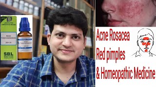 Acne Rosacea  Red Pimples  Homeopathic medicine for Rosacea  explain [upl. by Adnilre32]