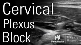 Cervical Plexus Block [upl. by Gnous]