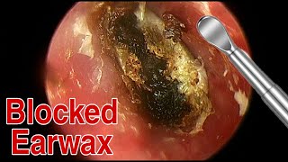 BIGGEST Ear Wax Difficult Removal  EP5  Doctor Anh [upl. by Colburn]