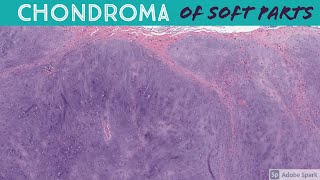 Chondroma of Soft Parts Extraskeletal Chondroma [upl. by Kartis]