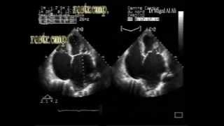 CHF with systolic and severe diastolic dysfunction [upl. by Yesnyl]