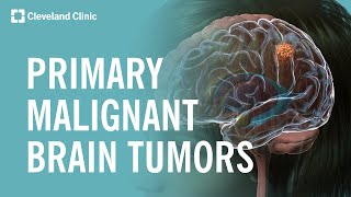 What Are Primary Malignant Brain Tumors [upl. by Oza]