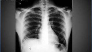 Chest xray pneumoperitonuem air under diaphragms [upl. by Nnagem]