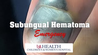 Subungual Hematoma Emergency and Trephination Procedure [upl. by Lelah]