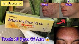 Aziderm 10 Cream Review  Azelaic Acid Cream Review [upl. by Gatias254]