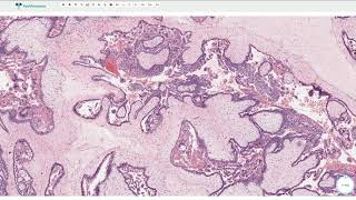 Complete Hydatidiform Mole  Histopathology [upl. by Arand]