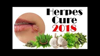 Latest Herpes Cure 2018  Cure Herpes With Ayurveda [upl. by Haidabo]