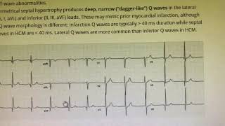 ECG changes in HCM [upl. by Phillie507]