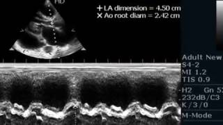 LARGE PERICARDIAL EFFUSION  ECHOCARDIOGRAPHY SERIES BY DRANKURKCHAUDHARI [upl. by Mert]