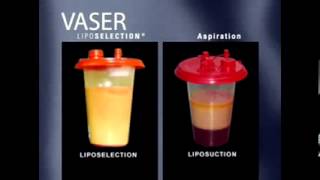 Vaser liposuction [upl. by Aihtyc]