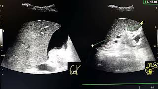 buddchiari syndrome ultrasound [upl. by Eemyaj]