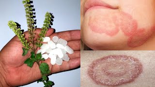 दाद खाज खुजली दिनाय कि सिर्फ़ 2 दिनों में जड़ से छुट्टी कर देगा ये नुस्खा  ringworm treatment home [upl. by Ellehcen]