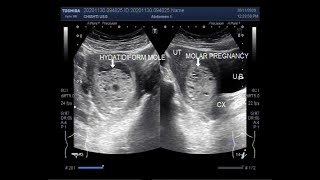 Ultrasound Video showing Hydatidiform Mole also called Molar Pregnancy [upl. by Bamford]