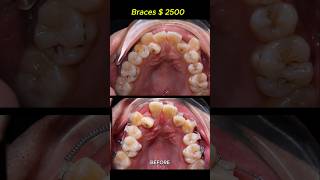 Cost  2500 for this case Braces crooked teeth braces orthodontist dentist [upl. by Freddy]