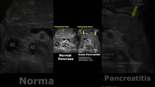 Acute Pancreatitis Ultrasound  Pancreas Normal Vs Abnormal USG shorts  ultrasound  radiology [upl. by Terrance]