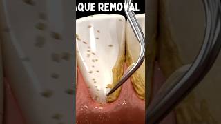 Dental plaque removal by water pick biology teethcleaning tartar dentaltartar biofilm [upl. by Fabiano]