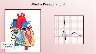 Advanced EKGs  WolffParkinsonWhite WPW Syndrome [upl. by Mota]