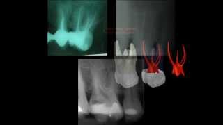 Primer molar superior [upl. by Esau]