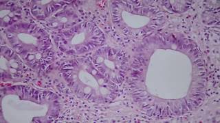 013 Intestinal metaplasia and low grade dysplasia in gastric biopsy [upl. by Nafis]