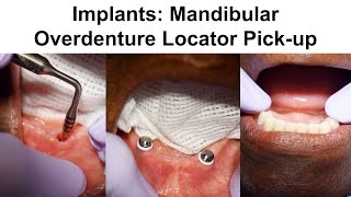 2 Implants Mandibular Overdenture Locator Pickup [upl. by Ytiak]