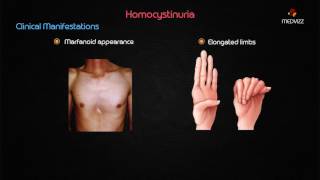 Homocystinuria  Usmle step 1 biochemistry Webinar based lecture [upl. by Giffy]