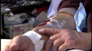 Getting Ready for Hemodialysis Blood Access  IKAN ch 7 [upl. by Spring548]