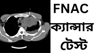 FNAC ক্যান্সার টেস্ট  cancer test [upl. by Gallard375]